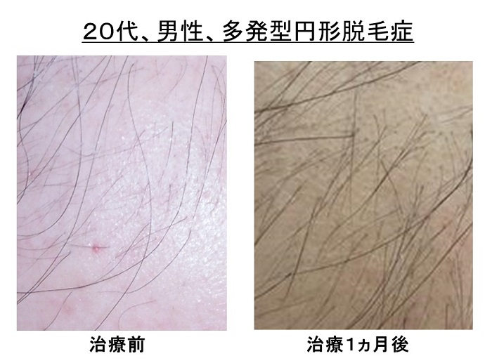 円形脱毛症　病院